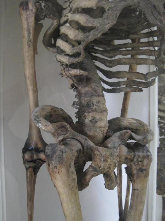 The pelvic bones of Janet Hyslop